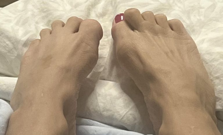 De-feet Toe Curling in Parkinson’s Disease